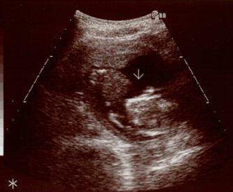 Ultra Sound Picture of baby