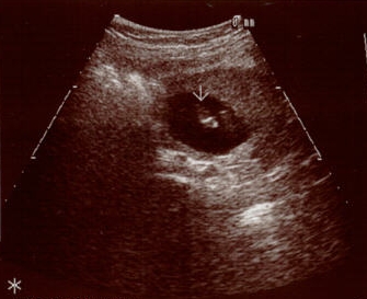 Ultra Sound Picture of Babys' feet